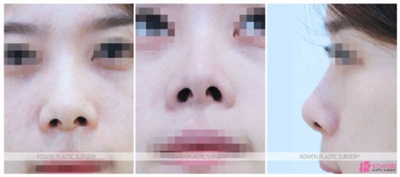 콧구멍짝짝이 개선과 들창코수술, 코성형후기로 살펴본 변화 과정 — 코성형 정보 이미지