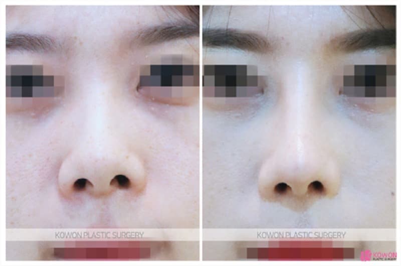 콧구멍짝짝이 개선과 들창코수술, 코성형후기로 살펴본 변화 과정 — 코성형 정보 이미지