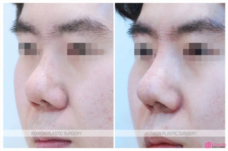 코재수술후기, 남자코수술과 콧볼축소수술을 함께 고려한 변화 — rhinoplasty information image