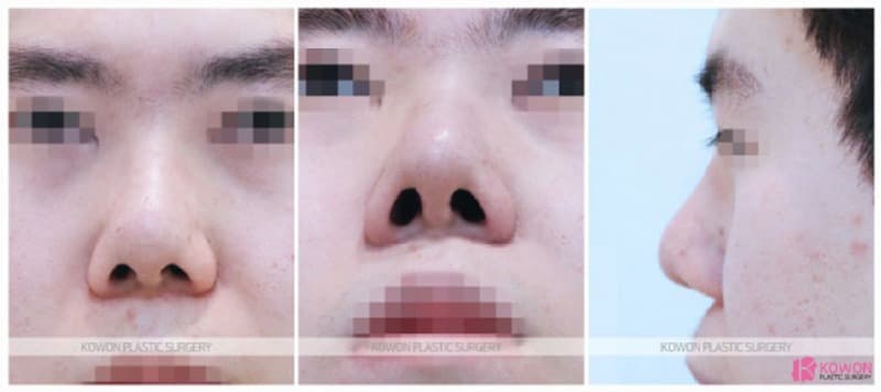 코재수술후기, 남자코수술과 콧볼축소수술을 함께 고려한 변화 — 코성형 정보 이미지
