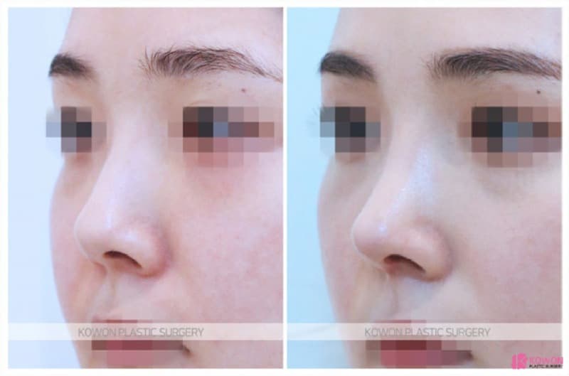 비중격만곡증 개선과 기능코성형, 여자코수술 전후 변화 — 코성형 정보 이미지