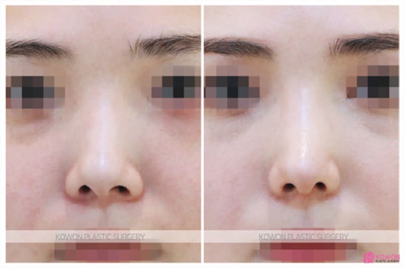 비중격만곡증 개선과 기능코성형, 여자코수술 전후 변화 — 코성형 정보 이미지
