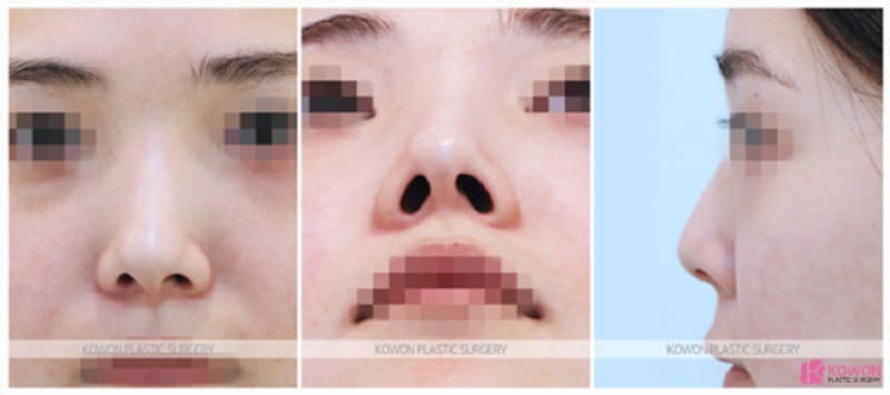 비중격만곡증 개선과 기능코성형, 여자코수술 전후 변화 — 코성형 정보 이미지