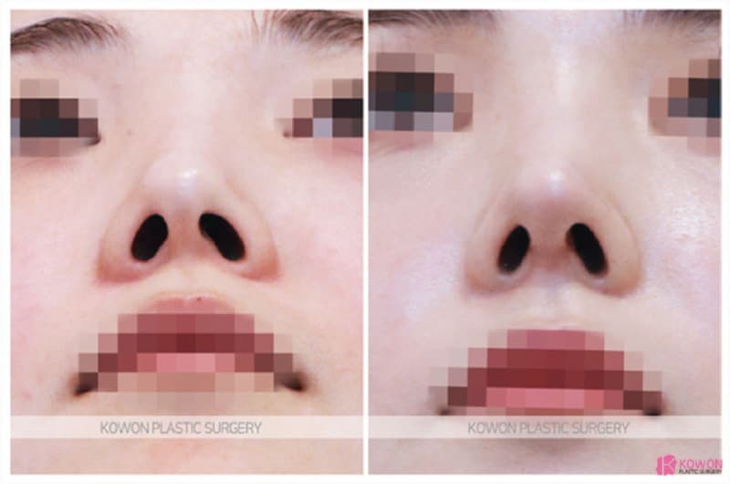 비중격만곡증 개선과 기능코성형, 여자코수술 전후 변화 — 코성형 정보 이미지