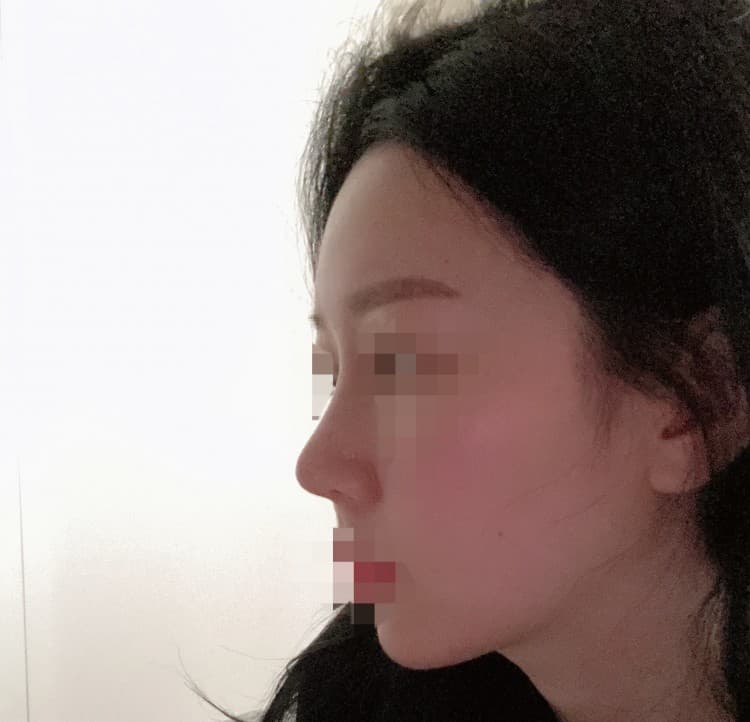 코수술 후기 9일차 사진입니다 :) 수술후기 사진 1