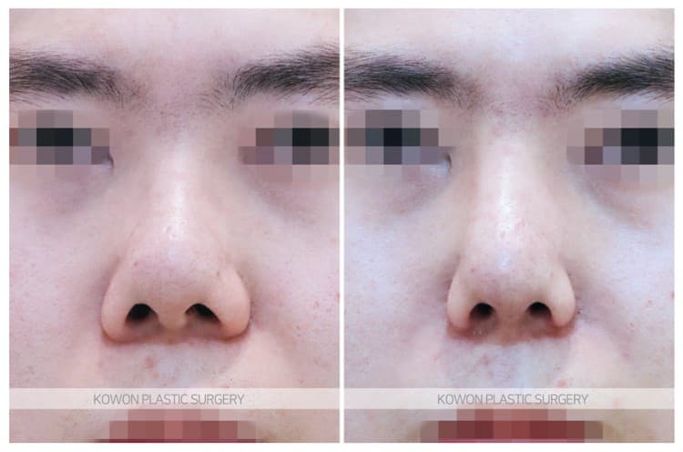 남자 복코재수술 전후사진 : 남자 콧날개줄이기, 비순각 각도 개선 전후사진 surgery record photo