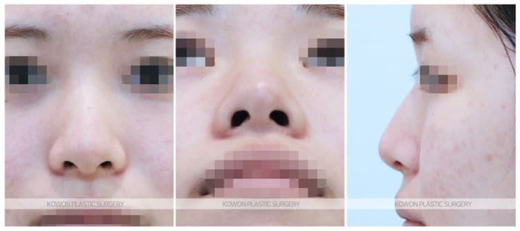 코수술 상담 칼럼 : 여자 늑입자코수술, 실리콘에 거부감이 있고 무보형물 수술을 원하시는 경우 수술 기록 사진