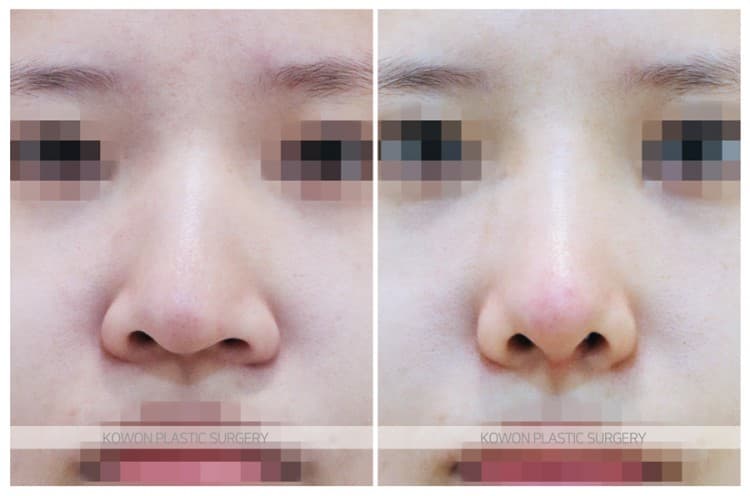 ภาพบันทึกการผ่าตัด 여자 매부리코 전후사진 : 긴코, 휜코교정, 코끝내림근제거, 매부리코 절골술 전후사진
