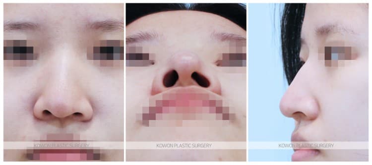 여자 매부리코 전후사진 : 긴코, 휜코교정, 코끝내림근제거, 매부리코 절골술 전후사진 수술 기록 사진