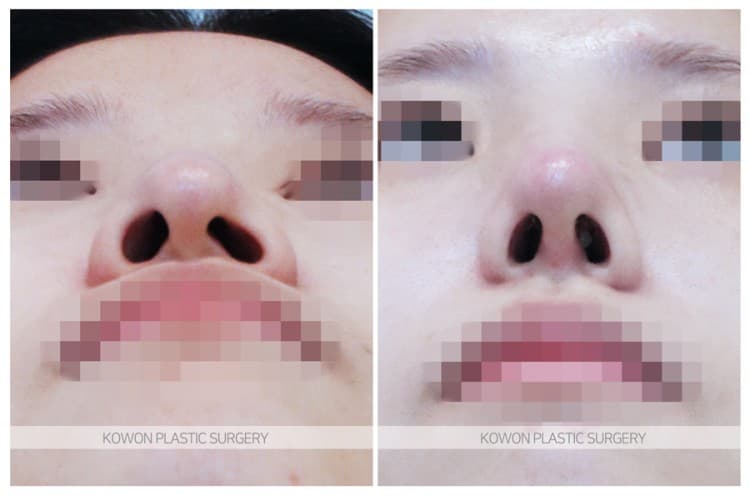 ภาพบันทึกการผ่าตัด 여자 매부리코 전후사진 : 긴코, 휜코교정, 코끝내림근제거, 매부리코 절골술 전후사진