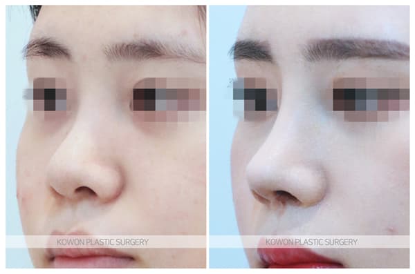 여자 복코 전후사진 : 짧은코 복코이면서 휜코느낌이 있는 경우 비중격연장 2주차 수술전후사진 수술 기록 사진