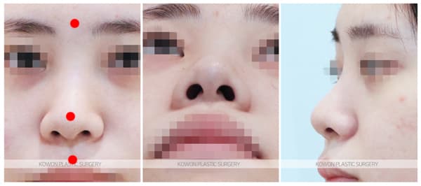 여자 복코 전후사진 : 짧은코 복코이면서 휜코느낌이 있는 경우 비중격연장 2주차 수술전후사진 수술 기록 사진
