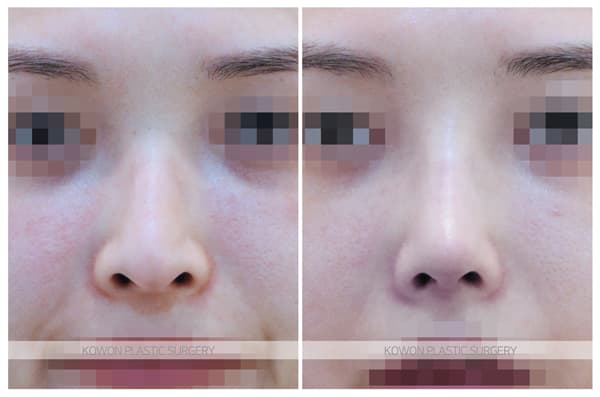여자 매부리코 용코 수술전후사진 : 좁고 높은 휜코, 높고 화려한코, 수술 2주 전후사진 수술 기록 사진