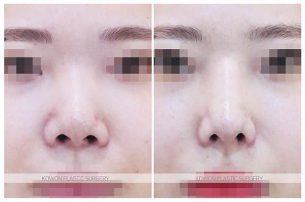 여자 코재수술 자가늑코재수술 전후사진 : 자가늑연골, 자가늑입자를 사용한 기증늑연골 재수술전후사진 surgery record photo