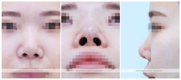 여자 코재수술 자가늑코재수술 전후사진 : 자가늑연골, 자가늑입자를 사용한 기증늑연골 재수술전후사진 수술 기록 사진