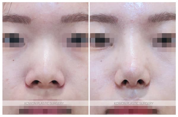 ภาพบันทึกการผ่าตัด 여자 복코, 낮은코수술 전후사진 : 콧등절골술이 필요한 경우