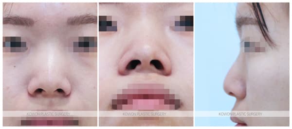 여자 복코, 낮은코수술 전후사진 : 콧등절골술이 필요한 경우 수술 기록 사진
