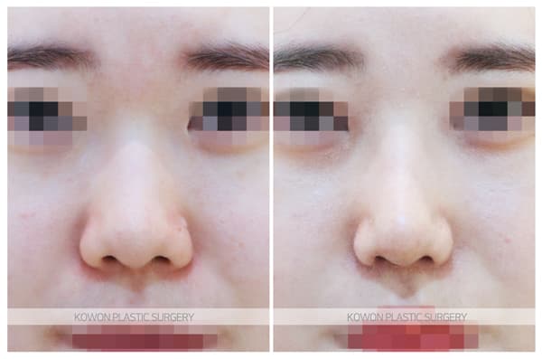 실코성형 코실제거 전후사진 : 녹는실, 하이코제거, 미스코제거, 베이코제거 후 코재수술 수술 기록 사진