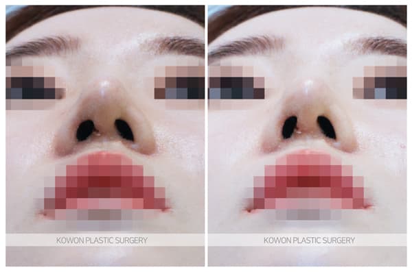 실코성형 코실제거 전후사진 : 녹는실, 하이코제거, 미스코제거, 베이코제거 후 코재수술 수술 기록 사진