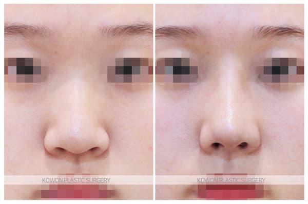 낮고긴코 수술전후사진 : 화살코, 처진코에서 코끝내림근제거를 해야하는 경우 수술 기록 사진