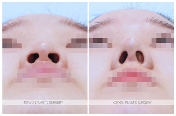 ภาพบันทึกการผ่าตัด 낮고긴코 수술전후사진 : 화살코, 처진코에서 코끝내림근제거를 해야하는 경우