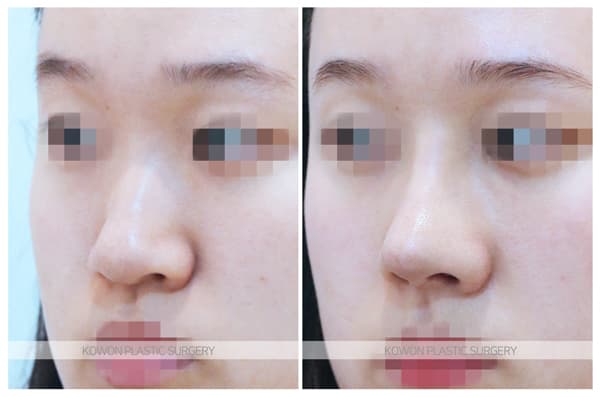 낮고긴코 수술전후사진 : 화살코, 처진코에서 코끝내림근제거를 해야하는 경우 수술 기록 사진
