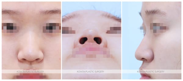 낮고긴코 수술전후사진 : 화살코, 처진코에서 코끝내림근제거를 해야하는 경우 수술 기록 사진