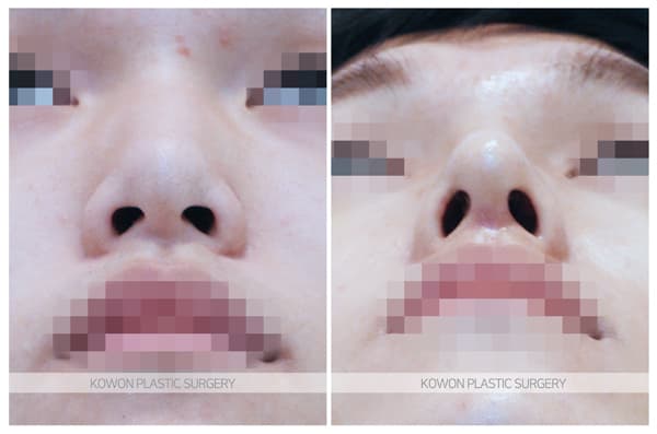 남자매부리코 전후사진 : 낮은 매부리코 콧등절골술 , 남자다운 높은 콧대 수술 기록 사진