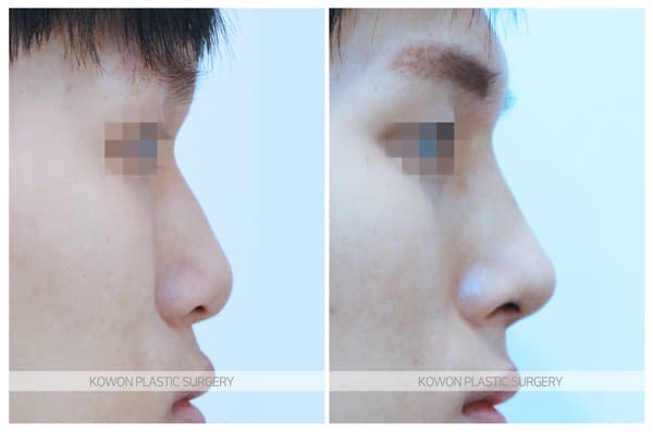 ภาพบันทึกการผ่าตัด 남자매부리코 전후사진 : 낮은 매부리코 콧등절골술 , 남자다운 높은 콧대