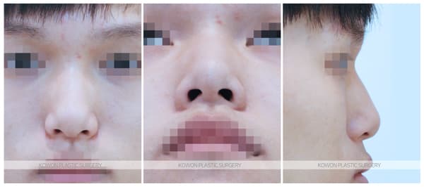 남자매부리코 전후사진 : 낮은 매부리코 콧등절골술 , 남자다운 높은 콧대 수술 기록 사진