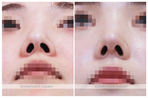 짧은코수술 전후사진 : 비중격만곡증이 있고 코끝이 짧은 경우 여성스럽고 예쁜 코 수술 기록 사진