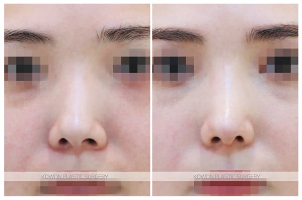 짧은코수술 전후사진 : 비중격만곡증이 있고 코끝이 짧은 경우 여성스럽고 예쁜 코 수술 기록 사진