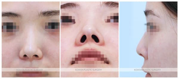 짧은코수술 전후사진 : 비중격만곡증이 있고 코끝이 짧은 경우 여성스럽고 예쁜 코 수술 기록 사진