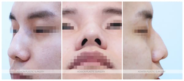 남자 매부리코 수술전후사진 : 비중격만곡증, 매부리코 심한 경우 매부리코절골술로 해결 수술 기록 사진