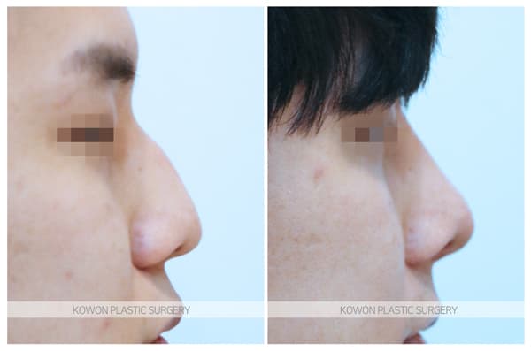 남자 매부리코 수술전후사진 : 비중격만곡증, 매부리코 심한 경우 매부리코절골술로 해결 수술 기록 사진