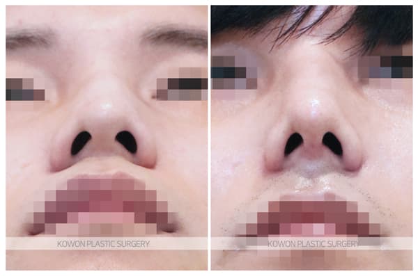 ภาพบันทึกการผ่าตัด 남자 매부리코 수술전후사진 : 비중격만곡증, 매부리코 심한 경우 매부리코절골술로 해결