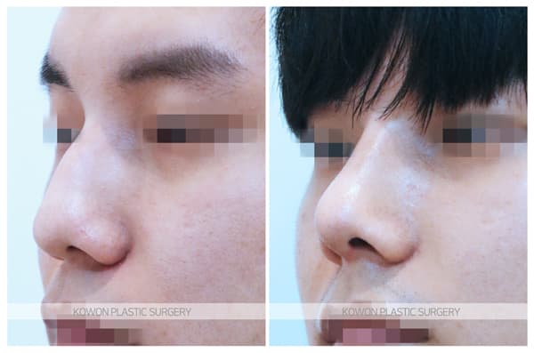 남자 매부리코 수술전후사진 : 비중격만곡증, 매부리코 심한 경우 매부리코절골술로 해결 수술 기록 사진
