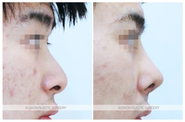 ภาพบันทึกการผ่าตัด 남자 휜코 전후사진 : 비중격만곡증과 비염이 생기는 원인과 수술법