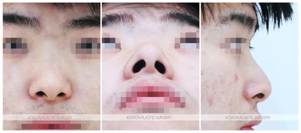 남자 휜코 전후사진 : 비중격만곡증과 비염이 생기는 원인과 수술법 수술 기록 사진