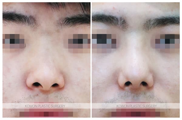 남자 휜코 전후사진 : 비중격만곡증과 비염이 생기는 원인과 수술법 수술 기록 사진