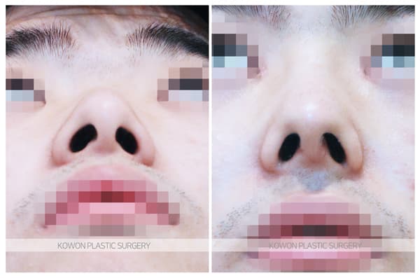 남자 휜코 전후사진 : 비중격만곡증과 비염이 생기는 원인과 수술법 수술 기록 사진