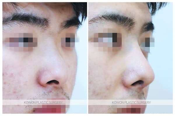 남자 휜코 전후사진 : 비중격만곡증과 비염이 생기는 원인과 수술법 surgery record photo