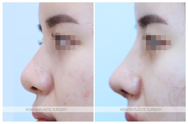 ภาพบันทึกการผ่าตัด 여자 주먹코 수술전후사진 : 여자복코 , 콧날개자르기, 콧볼축소 수술 2주차 흉터 및 붓기