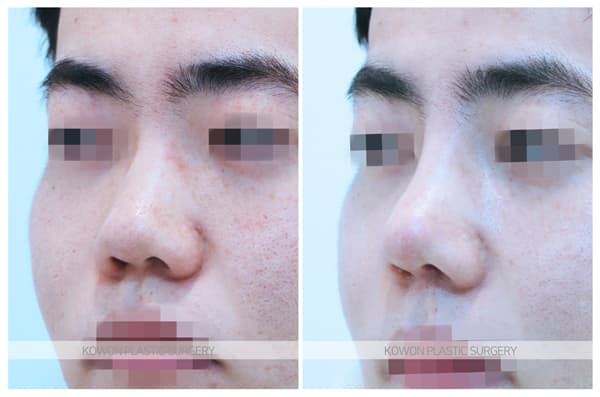 남자 짧은코 전후사진 : 남자 복코수술 두꺼운 피부의 코끝비중격연장 수술 기록 사진