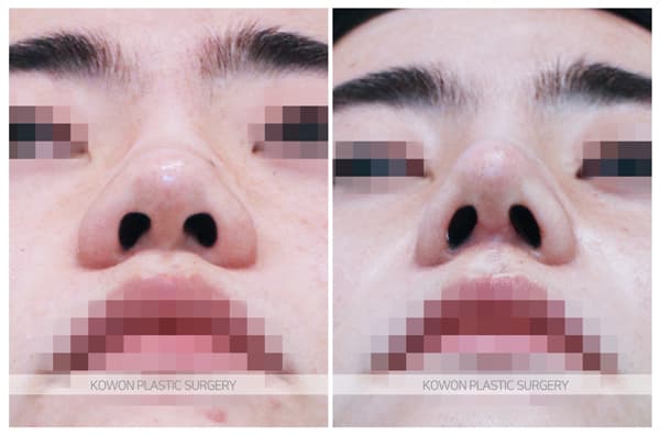 남자 짧은코 전후사진 : 남자 복코수술 두꺼운 피부의 코끝비중격연장 수술 기록 사진