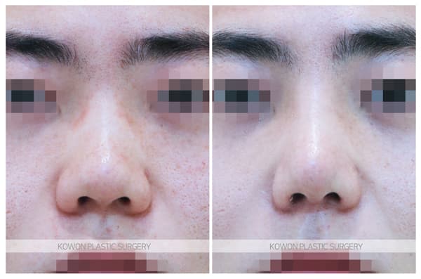 남자 짧은코 전후사진 : 남자 복코수술 두꺼운 피부의 코끝비중격연장 수술 기록 사진