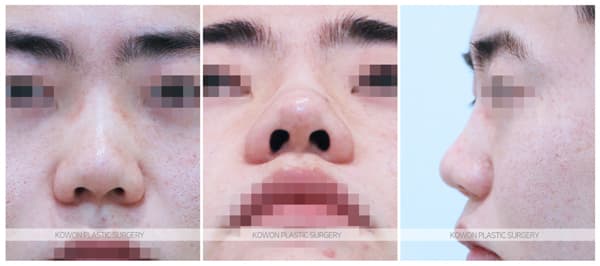 남자 짧은코 전후사진 : 남자 복코수술 두꺼운 피부의 코끝비중격연장 수술 기록 사진