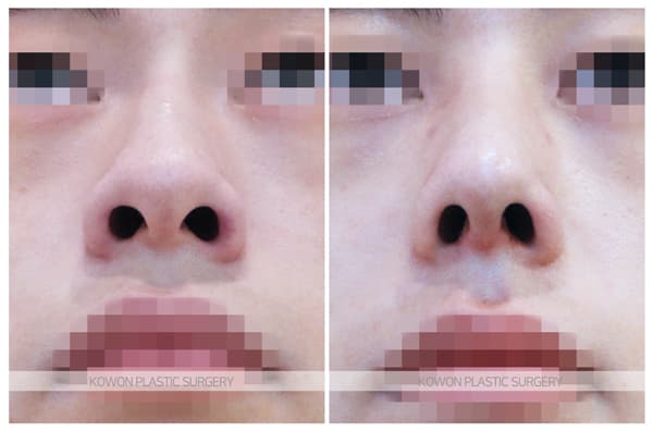 남자 매부리코 교정 전후사진 : 크고 휜 남자코 무보형물 매부리코 수술 수술 기록 사진