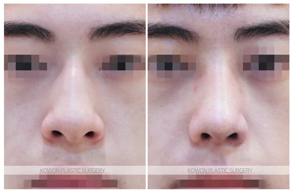 남자 매부리코 교정 전후사진 : 크고 휜 남자코 무보형물 매부리코 수술 수술 기록 사진
