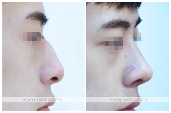 남자 매부리코 교정 전후사진 : 크고 휜 남자코 무보형물 매부리코 수술 수술 기록 사진